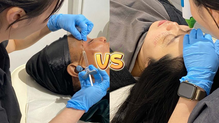 Thermage FLX vs Fillers