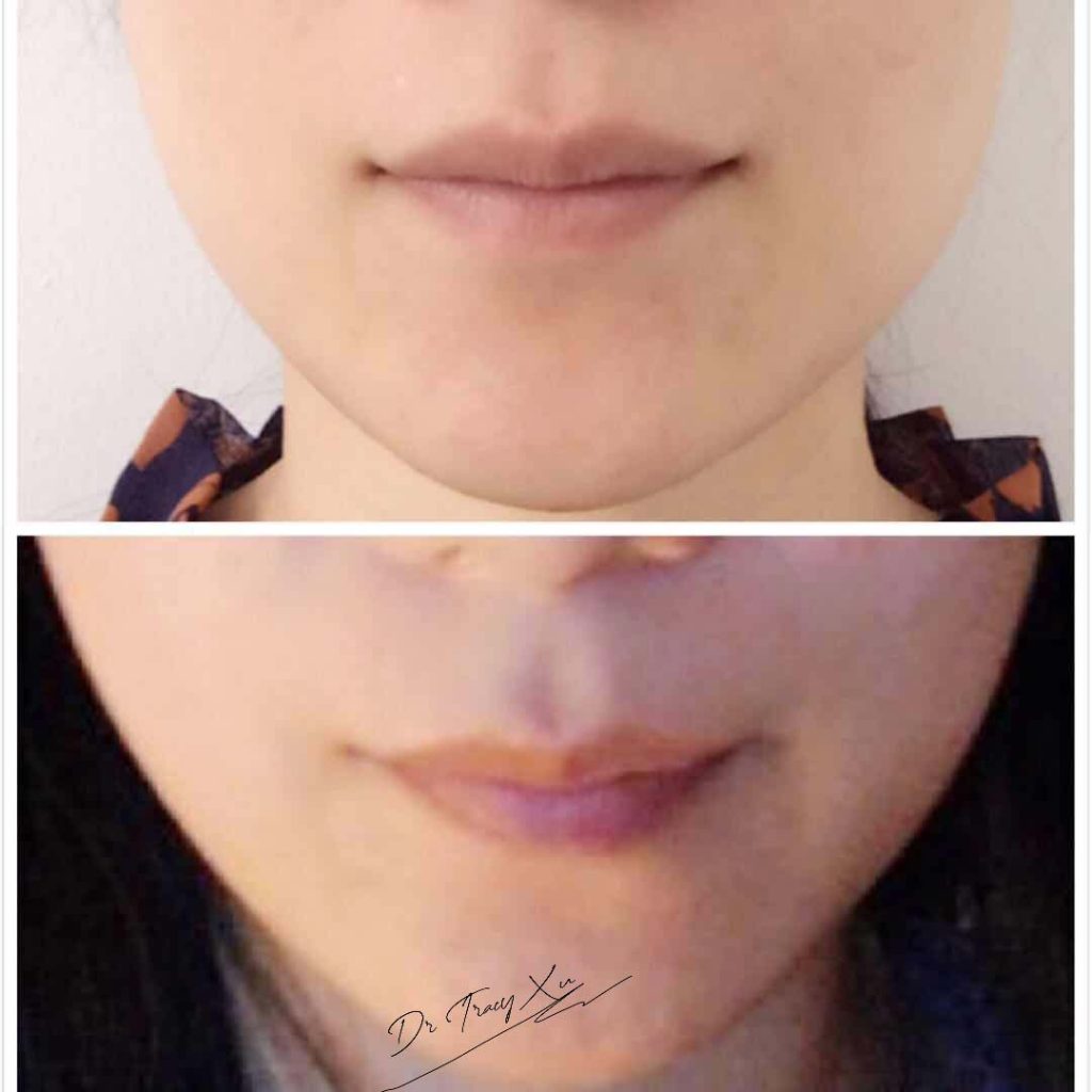 PM-Jaw-Slimming-03