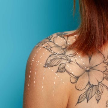 PicoSecond Solution for Pigmentation & Tattoos