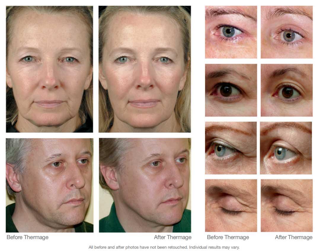 Thermage-FLX-Blog-659